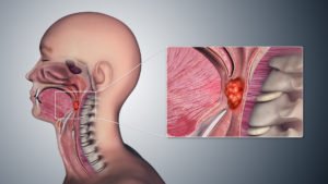 পর্নোগ্রাফিতে Throat Cancer